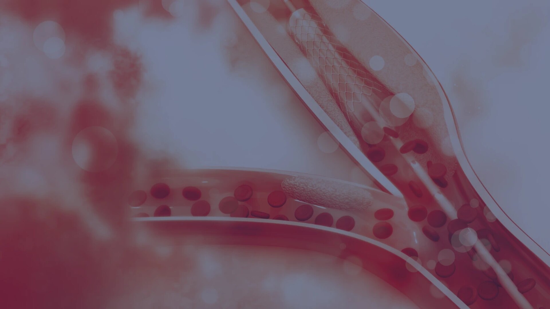 Tratamento de Aneurismas na Clínica Endovascular São Paulo
